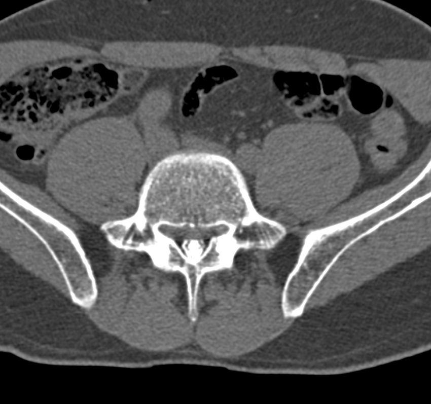Cervical dural CSF leak on MRI and CT treated by blood patch (Radiopaedia 49748-54996 B 114).png