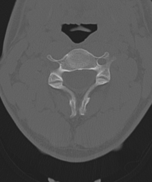 File:Cervical intercalary bone (Radiopaedia 35211-36748 Axial bone window 24).png