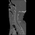 Cervical spine fractures with vertebral artery dissection (Radiopaedia 32135-33078 Sagittal bone window 19).jpg