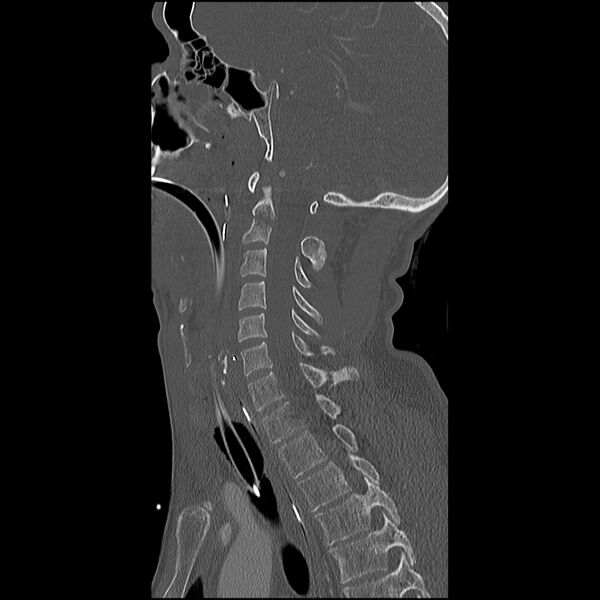 File:Cervical spine fractures with vertebral artery dissection (Radiopaedia 32135-33078 Sagittal bone window 19).jpg