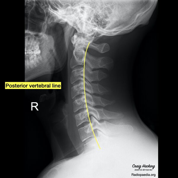 File:Cervical spine lines (Radiopaedia 76069-87571 F 1).jpeg