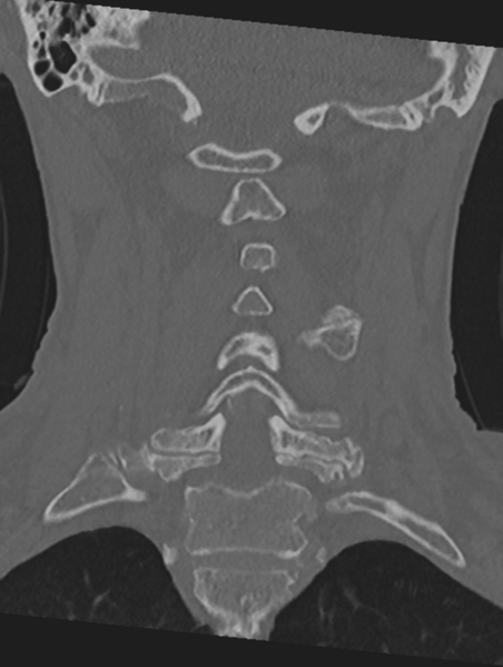 File:Cervical spondylolysis (Radiopaedia 49616-54811 Coronal bone window 31).png