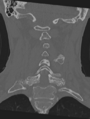 Cervical spondylolysis (Radiopaedia 49616-54811 Coronal bone window 31).png