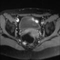 Cesarian section scar endometriosis (Radiopaedia 66520-75799 Axial T1 fat sat 16).jpg