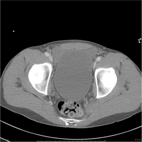 File:Chest and abdomen multi-trauma (Radiopaedia 26294-26426 bone window 79).jpg