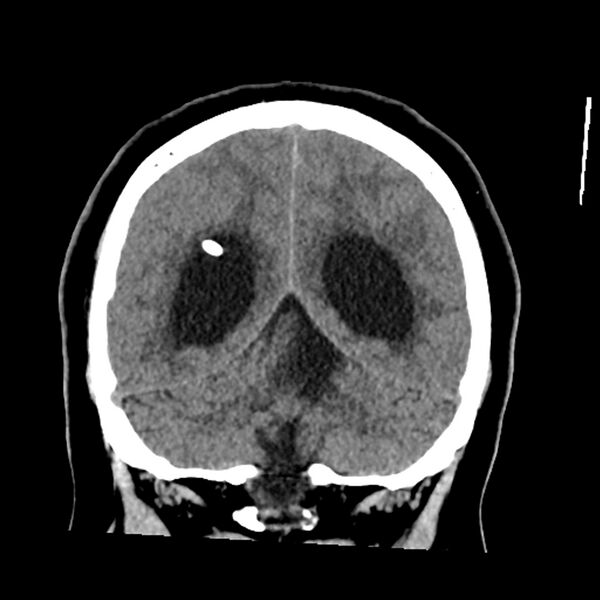 File:Chiasmatic-hypothalamic juvenile pilocytic astrocytoma (Radiopaedia 78533-91237 Coronal non-contrast 51).jpg