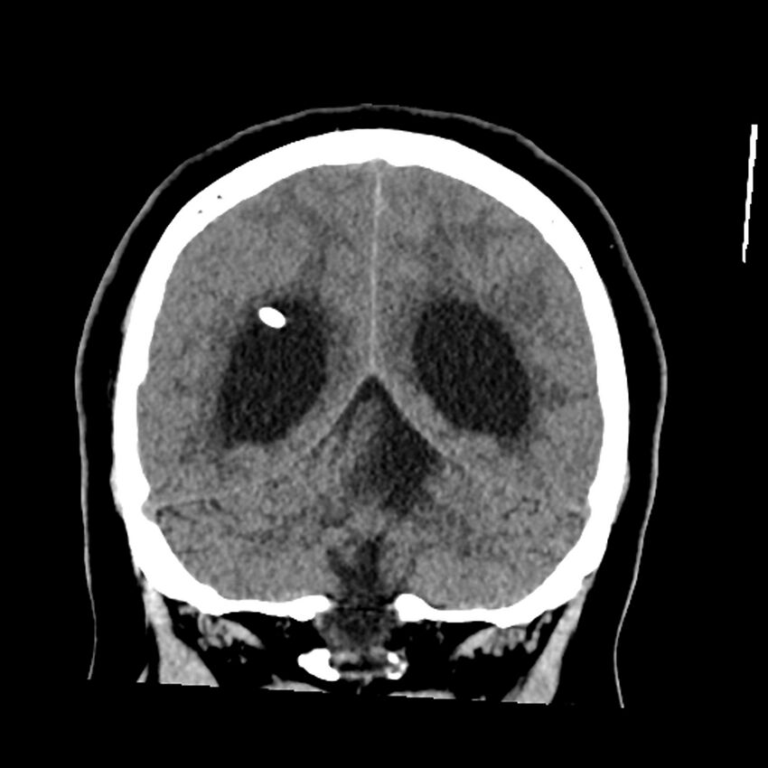 Chiasmatic-hypothalamic juvenile pilocytic astrocytoma (Radiopaedia 78533-91237 Coronal non-contrast 51).jpg