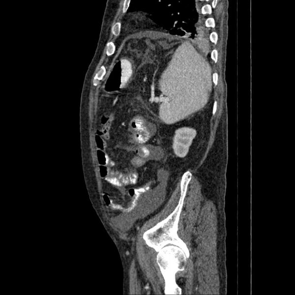 File:Cholangitis and abscess formation in a patient with cholangiocarcinoma (Radiopaedia 21194-21100 B 3).jpg
