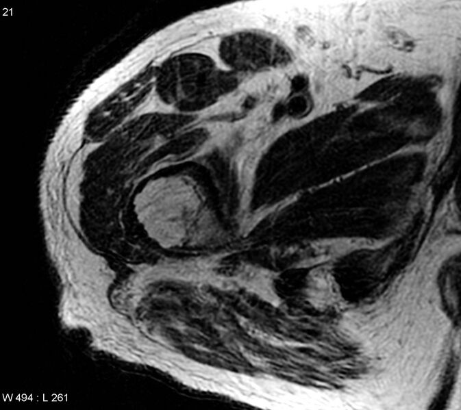 File:Chondrosarcoma - proximal femur (Radiopaedia 6171-7623 Axial T2 1).jpg