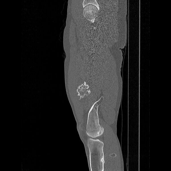 File:Chondrosarcoma arising from exostosis (Radiopaedia 59996-67507 Sagittal bone window 11).jpg