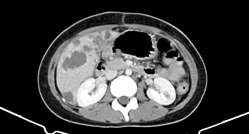 File:Choriocarcinoma liver metastases (Radiopaedia 74768-85766 A 95).jpg