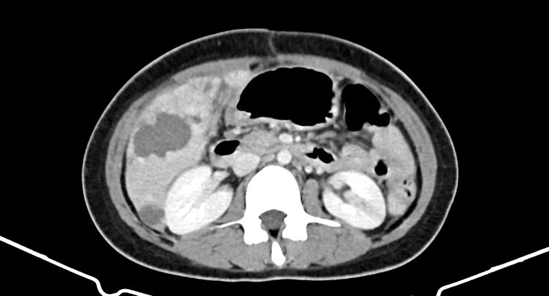 File:Choriocarcinoma liver metastases (Radiopaedia 74768-85766 A 98).jpg