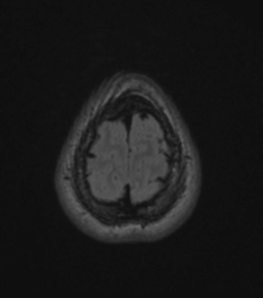 Choroid plexus carcinoma (Radiopaedia 91013-108553 Axial FLAIR C+ 194).jpg