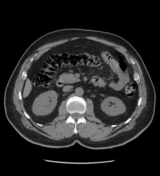 File:Chromophobe renal cell carcinoma (Radiopaedia 86879-103083 Axial non-contrast 39).jpg