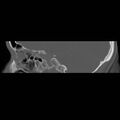 Chronic otomastoiditis (Radiopaedia 27138-27309 Sagittal bone window 24).jpg
