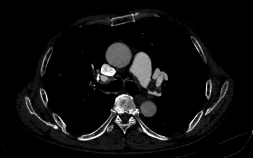 Chronic pulmonary embolism (Radiopaedia 91241-108843 B 79).jpg