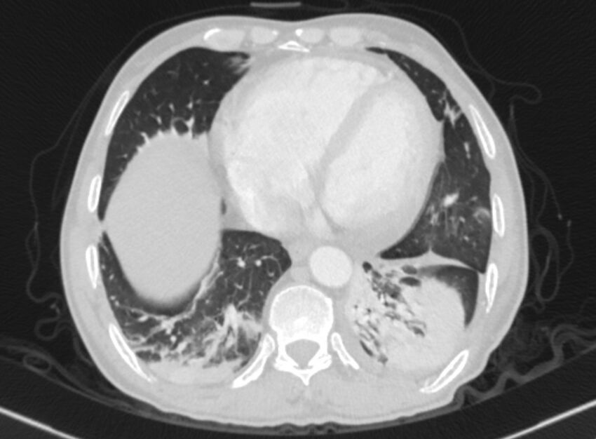 Chronic pulmonary embolism with bubbly consolidation (Radiopaedia 91248-108850 Axial lung window 118).jpg