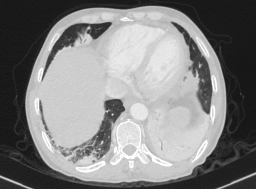 Chronic pulmonary embolism with bubbly consolidation (Radiopaedia 91248-108850 Axial lung window 124).jpg