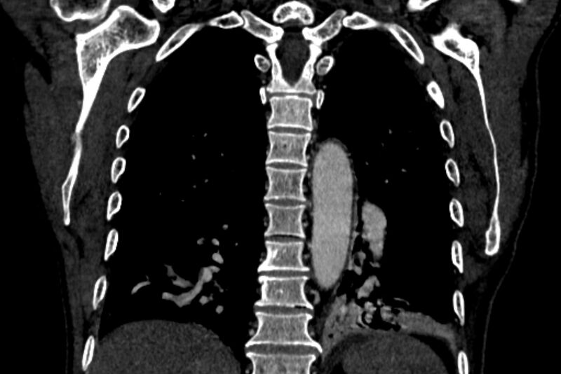 File:Chronic pulmonary embolism with bubbly consolidation (Radiopaedia 91248-108850 B 104).jpg