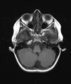 Chronic reactive multifocal osteomyelitis (CRMO) - mandible (Radiopaedia 56405-63069 Axial T1 22).jpg