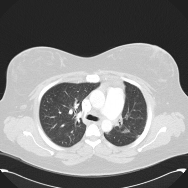 File:Chronic thromboembolic pulmonary hypertension (CTEPH) (Radiopaedia 74597-85531 Axial lung window 19).jpg