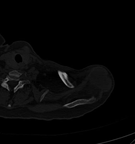 File:Clear cell chondrosarcoma - humerus (Radiopaedia 63104-71612 Axial bone window 13).jpg