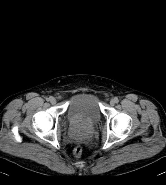 File:Clear cell renal cell carcinoma (Radiopaedia 85006-100539 Axial non-contrast 84).jpg
