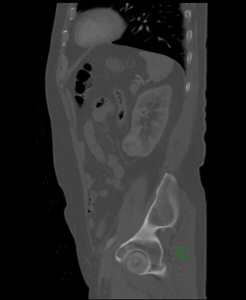 File:Clear cell renal cell carcinoma (Radiopaedia 85006-100539 Sagittal bone window 16).jpg