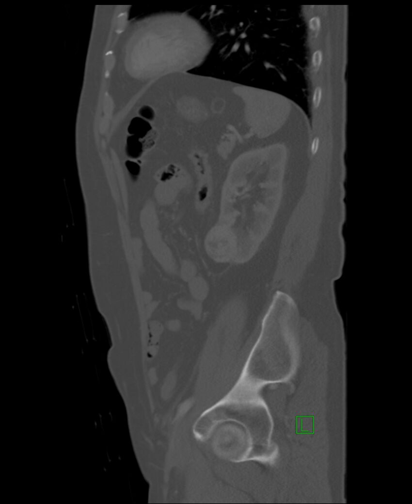 Clear cell renal cell carcinoma (Radiopaedia 85006-100539 Sagittal bone window 16).jpg