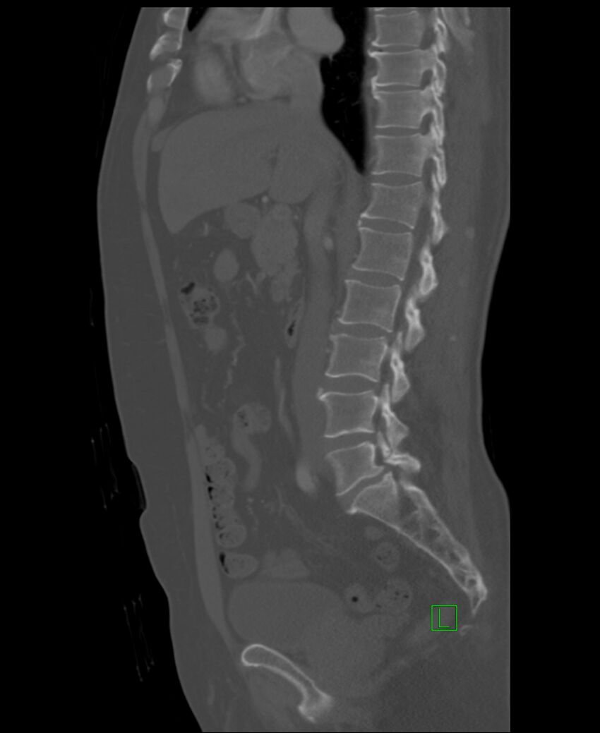 Clear cell renal cell carcinoma (Radiopaedia 85006-100539 Sagittal bone window 33).jpg