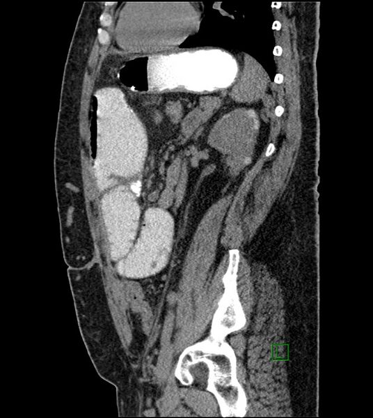 File:Closed-loop small bowel obstruction-internal hernia (Radiopaedia 78439-91096 C 56).jpg