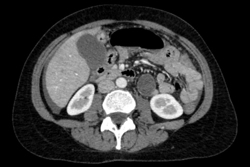 File:Closed loop small bowel obstruction (Radiopaedia 71211-81508 A 55).jpg
