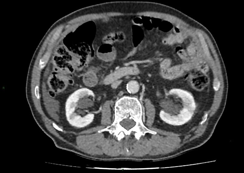 File:Closed loop small bowel obstruction with ischemia (Radiopaedia 84180-99456 A 51).jpg