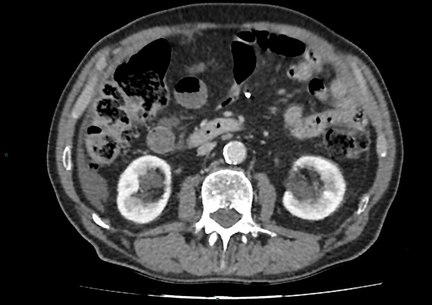Closed loop small bowel obstruction with ischemia (Radiopaedia 84180-99456 A 52).jpg