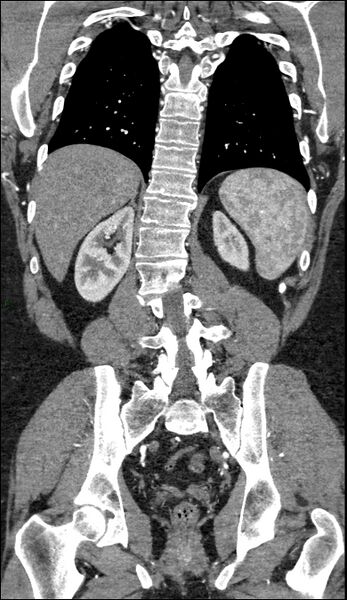 File:Coarctation of the aorta (Radiopaedia 74632-88521 B 182).jpg