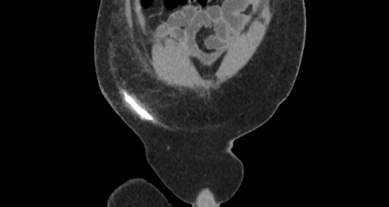 File:Colocutaneous fistula (Radiopaedia 56401-63062 C 11).jpg