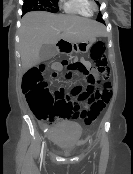 File:Colonic pseudo-obstruction (Radiopaedia 79752-92980 B 25).png