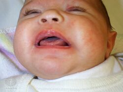 Oral candidiasis in an infant