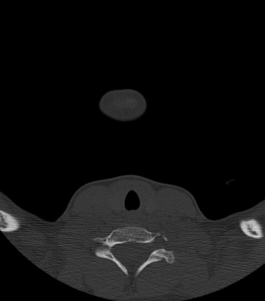 File:Nasoorbitoethmoid fracture (Radiopaedia 90044-107205 Axial bone window 4).jpg