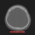 Nasopharyngeal carcinoma recurrence - skull base destruction (Radiopaedia 29107-29490 Axial bone window 25).jpg