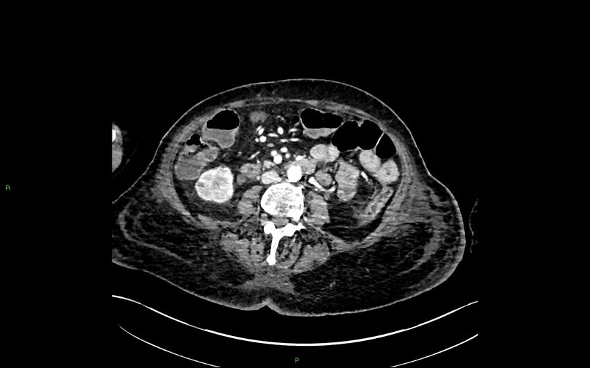 Neo-terminal ileal stricture (Crohn disease) (Radiopaedia 33790-34948 A 218).jpg