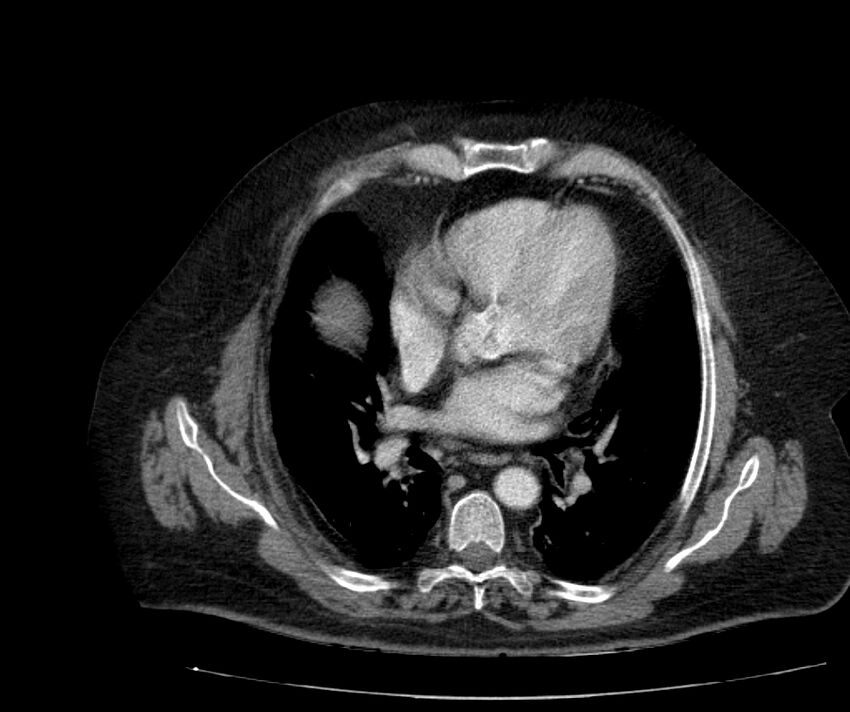 Nephroptosis with inguinal hernia containing perirenal fat (Radiopaedia 56632-63391 C 14).jpg