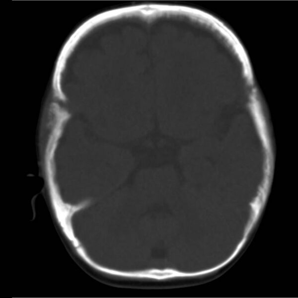 File:Neuroblastoma with skull metastases (Radiopaedia 30326-30958 Axial bone window 6).jpg