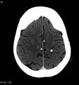 Neurocysticercosis (Radiopaedia 7773-8596 C+ delayed 14).jpg