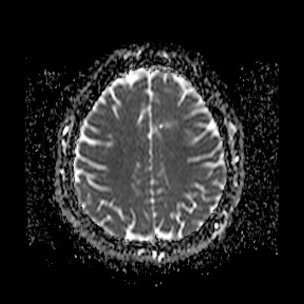 File:Neurofibromatosis type 2 (Radiopaedia 67470-76871 Axial ADC 17).jpg