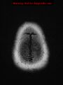 Neuroglial cyst (Radiopaedia 10713-11184 Axial FLAIR 1).jpg