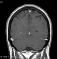 Neurosarcoidosis (Radiopaedia 10930-17204 Coronal T1 C+ 16).jpg
