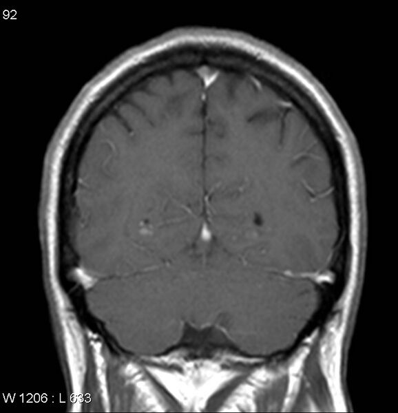 File:Neurosarcoidosis (Radiopaedia 10930-17204 Coronal T1 C+ 16).jpg