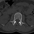 Normal CT lumbar spine (Radiopaedia 53981-60118 Axial bone window 22).jpg