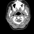 Normal CT of the neck (Radiopaedia 14575-14500 Axial C+ 23).jpg